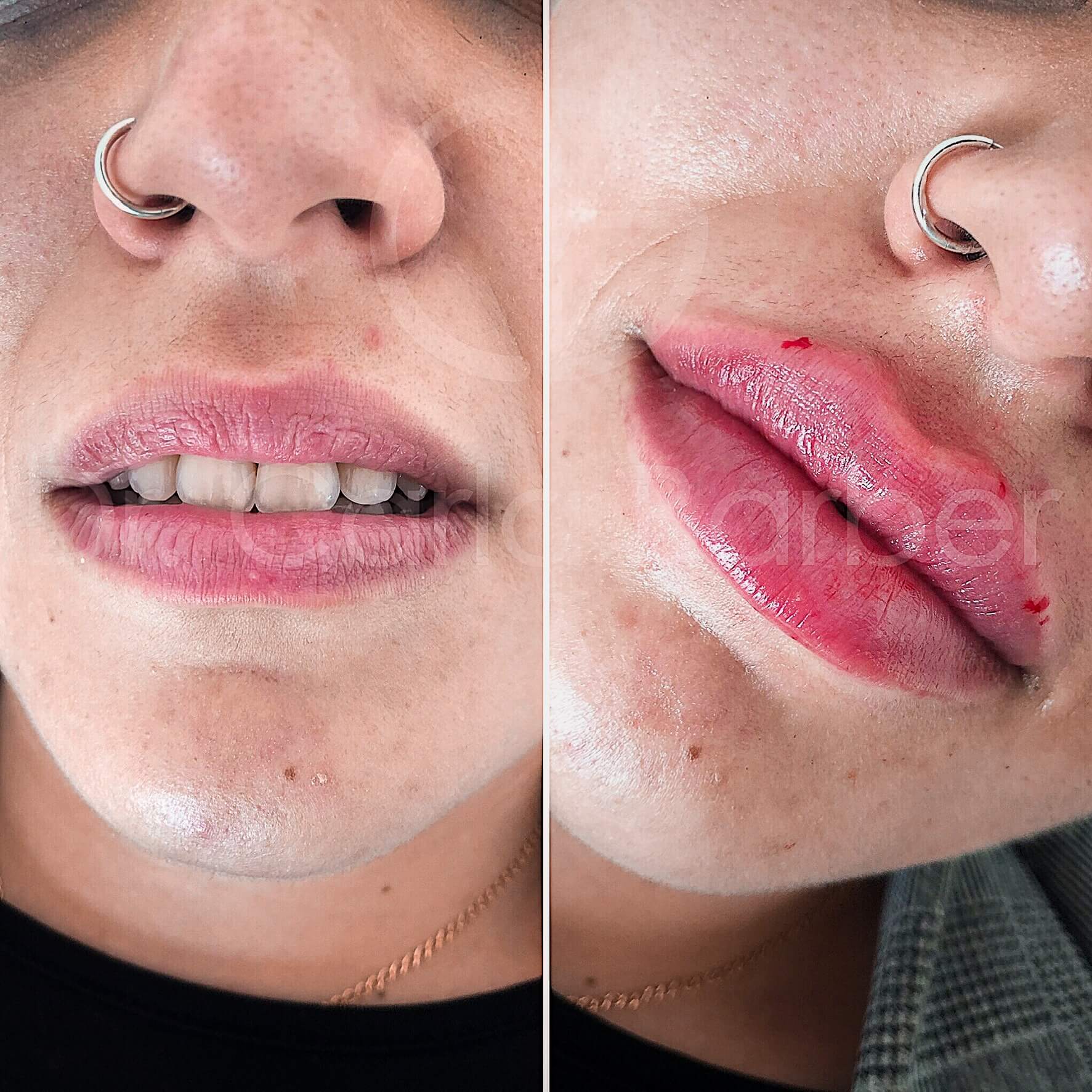 Antes y después de aumento de labios con tratamiento de ácido hialurónico