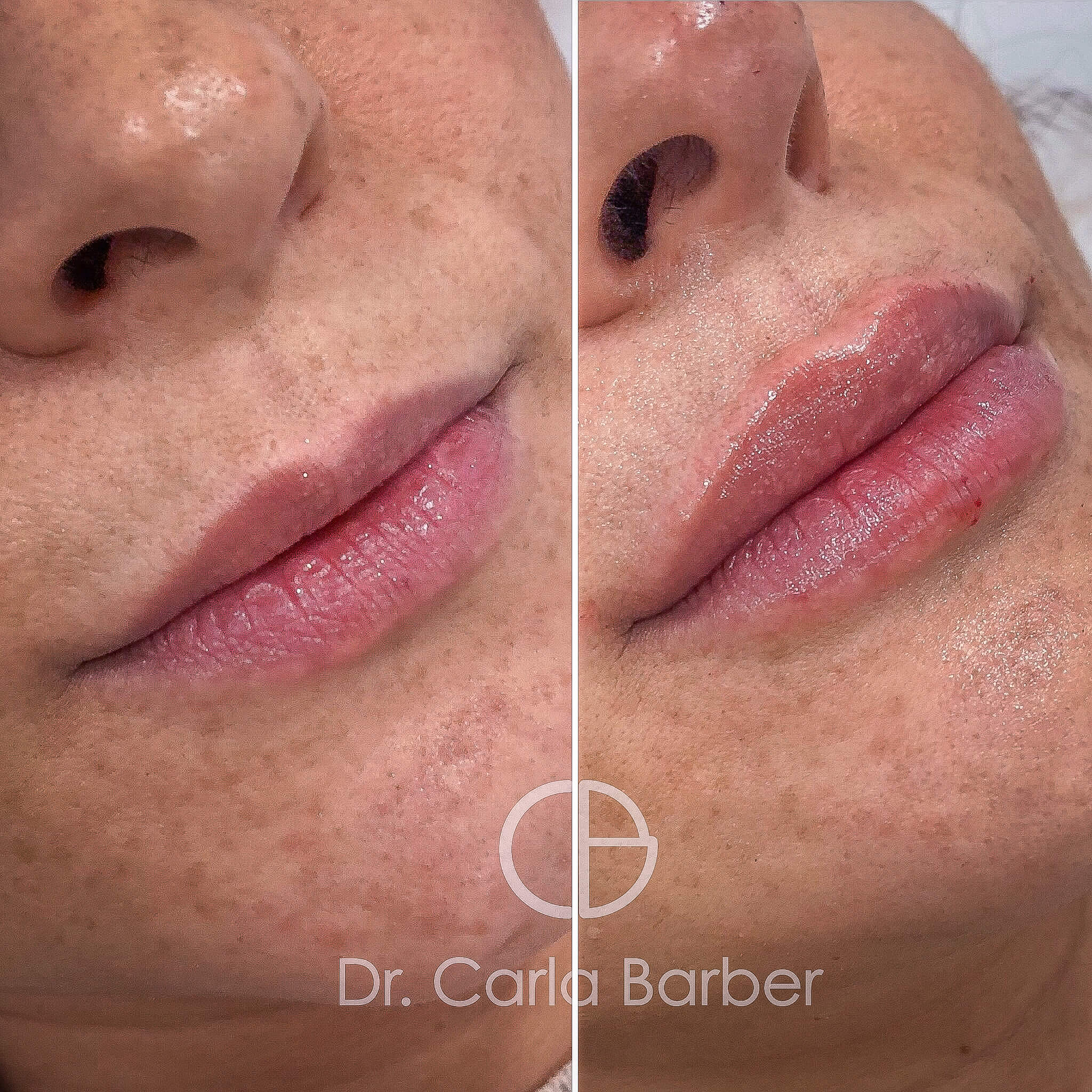 Tratamiento aumento de labios Dr. Carla Barber