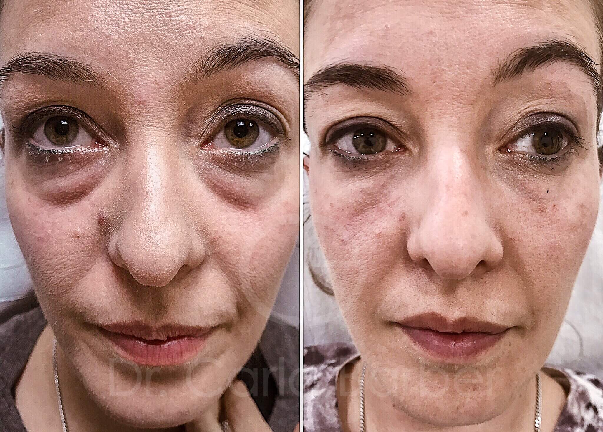 Casos antes y después de ojeras con tratamiento de ácido hialurónico