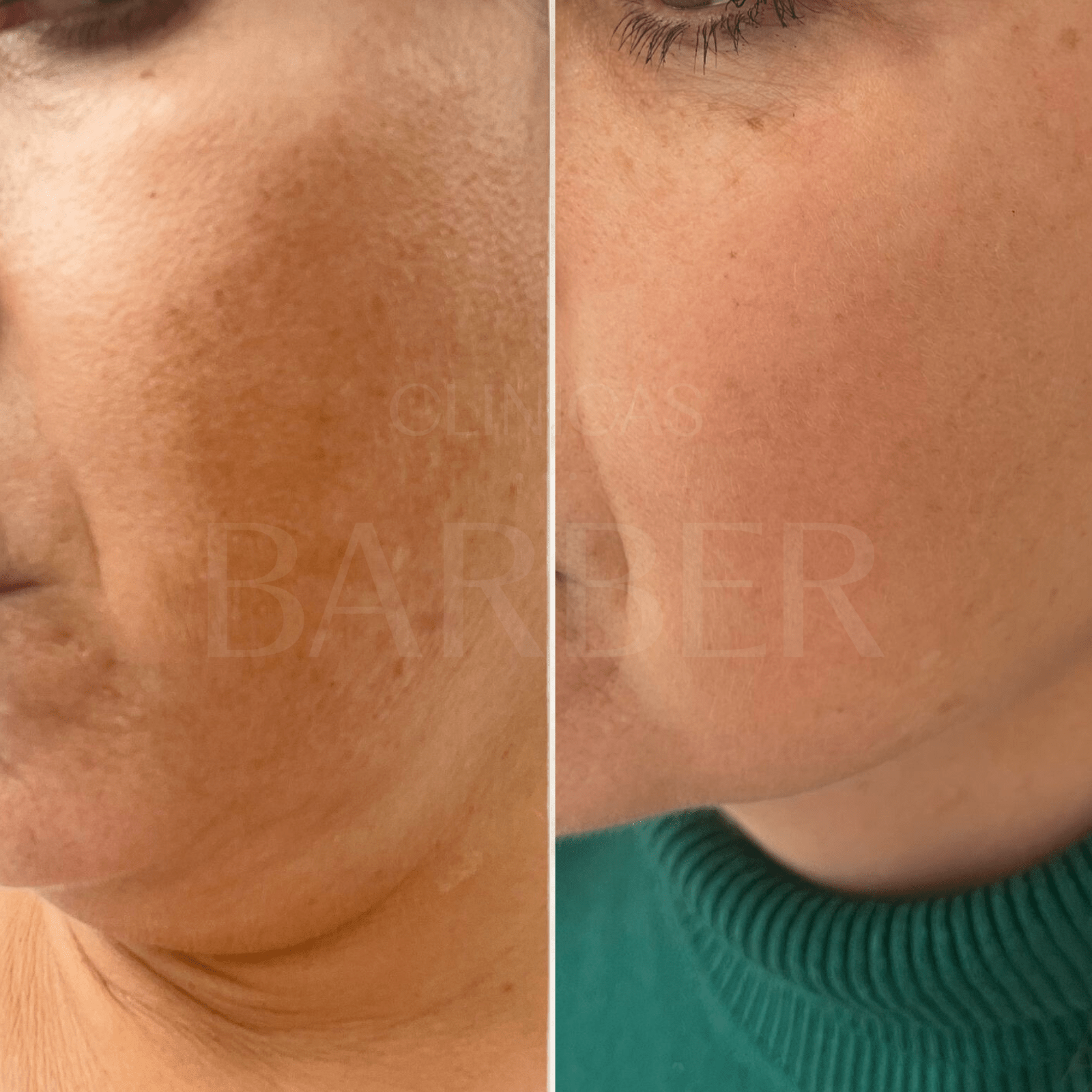 picolaser melasma