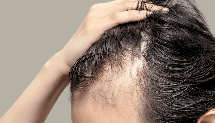 protocolo MEDIHAIR alopecia inflamatoria