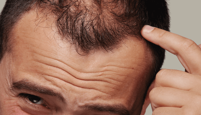 exosomas Alopecia y pérdida de pelo